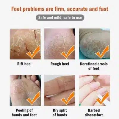 Επαναφορτιζόμενη Συσκευή Περιποίησης Πέλματος και Απομάκρυνσης Κάλων Με Απορρόφηση-Callus Remover Επαναφορτιζόμενη Συσκευή Περιποίησης Πέλματος και Απομάκρυνσης Κάλων Με Απορρόφηση-Callus Remover