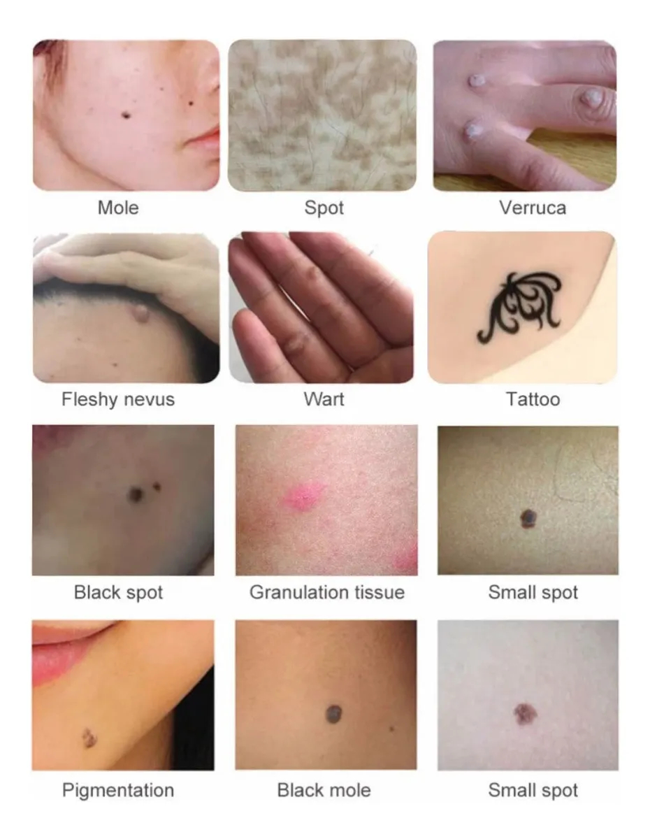 Ψηφιακό Plasma Pen για Σπίλους, Κηλίδες & Τατουάζ - 9 Επίπεδα Ισχύος με LCD Οθόνη & Φωτισμό Ψηφιακό Plasma Pen για Σπίλους, Κηλίδες & Τατουάζ - 9 Επίπεδα Ισχύος με LCD Οθόνη & Φωτισμό