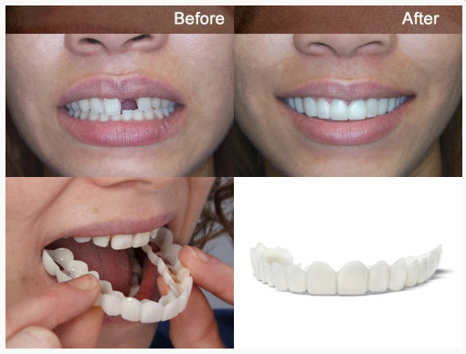 Snap On Smile - Μασελάκι Μεταμόρφωσης Χαμόγελου - Αφαιρούμενη Οδοντική Όψη Ρητίνης για Άνω ή Κάτω Γνάθο Snap On Smile - Μασελάκι Μεταμόρφωσης Χαμόγελου - Αφαιρούμενη Οδοντική Όψη Ρητίνης για Άνω ή Κάτω Γνάθο