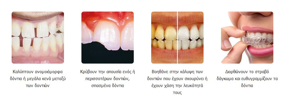 Snap On Smile - Μασελάκι Μεταμόρφωσης Χαμόγελου - Αφαιρούμενη Οδοντική Όψη Ρητίνης για Άνω ή Κάτω Γνάθο Snap On Smile - Μασελάκι Μεταμόρφωσης Χαμόγελου - Αφαιρούμενη Οδοντική Όψη Ρητίνης για Άνω ή Κάτω Γνάθο