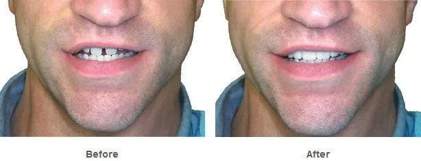 Snap On Smile - Μασελάκι Μεταμόρφωσης Χαμόγελου - Αφαιρούμενη Οδοντική Όψη Ρητίνης για Άνω ή Κάτω Γνάθο Snap On Smile - Μασελάκι Μεταμόρφωσης Χαμόγελου - Αφαιρούμενη Οδοντική Όψη Ρητίνης για Άνω ή Κάτω Γνάθο