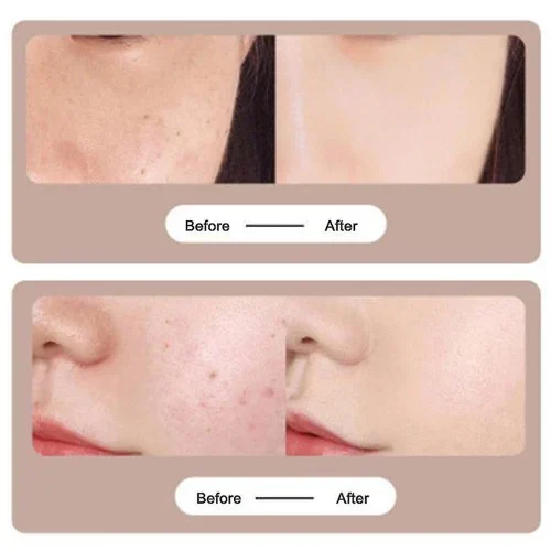 Στυλό λέιζερ αφαίρεσης ελιών και θεραπεία του δέρματος κατά της ακμής Mole Removal Pen Στυλό λέιζερ αφαίρεσης ελιών και θεραπεία του δέρματος κατά της ακμής Mole Removal Pen